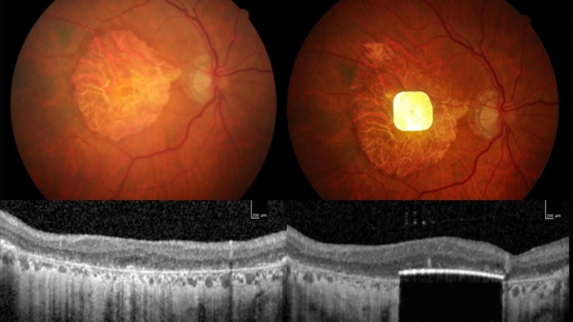 Implant ocular cu celule fotovoltaice redă parţial vederea pacienţilor cu degenerescenţă maculară