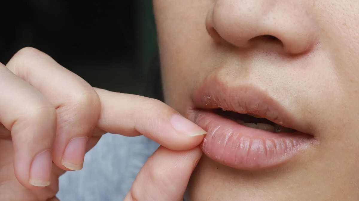 Buze crăpate: 11 soluţii