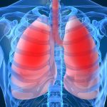 48 de ore fără plămâni: sistem pulmonar artificial a ţinut în viaţă un pacient până la transplant