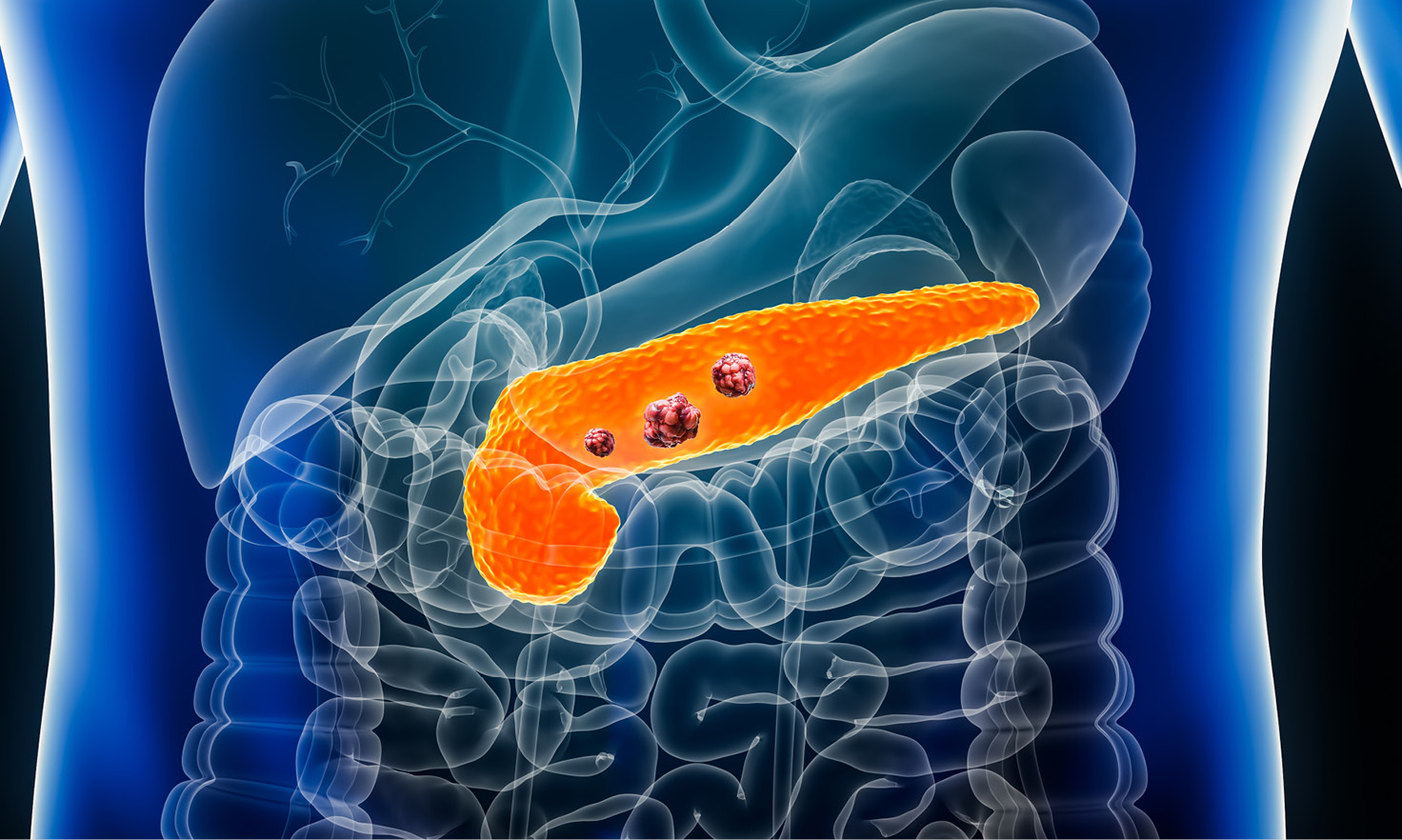Pastilă experimentală ar putea dubla supravieţuirea pacienţilor cu cancer pancreatic avansat